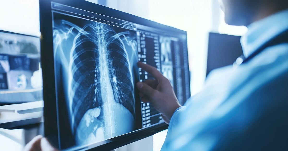 xray of asbestos in lungs