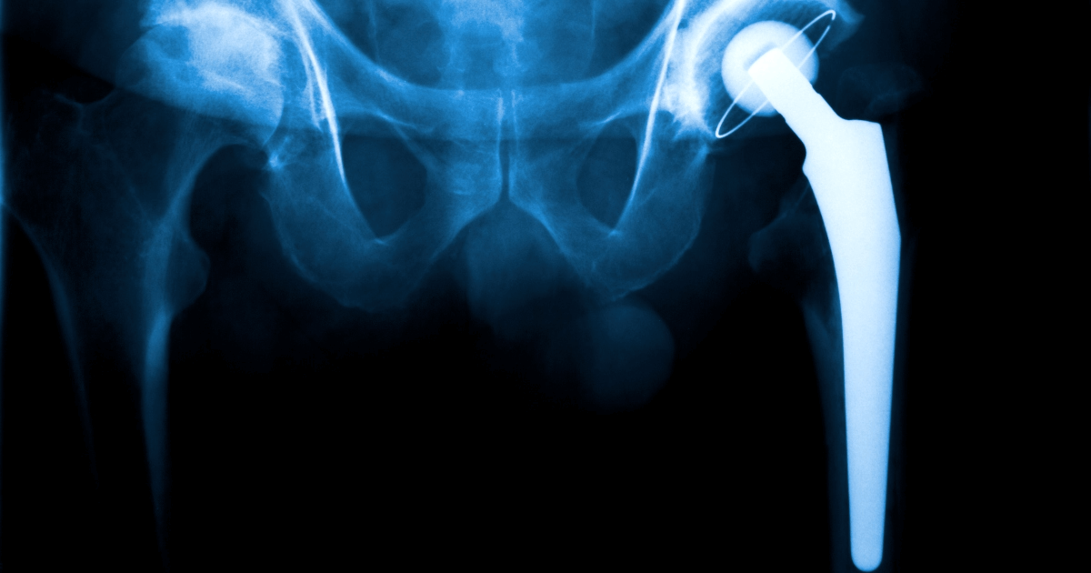 X-ray of replaced hip